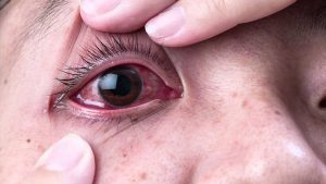 Cách chữa bệnh đau mắt hàn